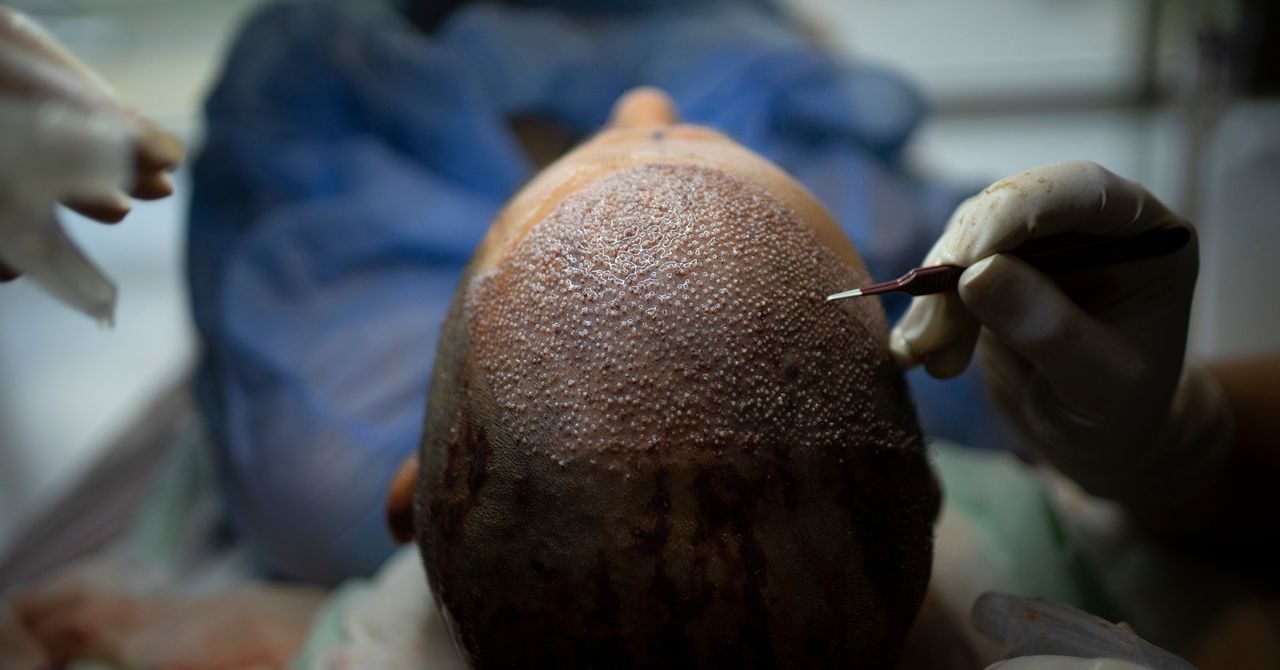 Turkey's Hair Transplant Industry and Its Medical Innovation