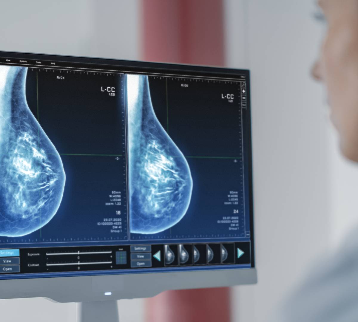 Nvidia's AI Tools Enhance Breast Cancer Diagnosis and Treatment